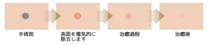 手術前表面を電気的に除去します治癒過程治癒後